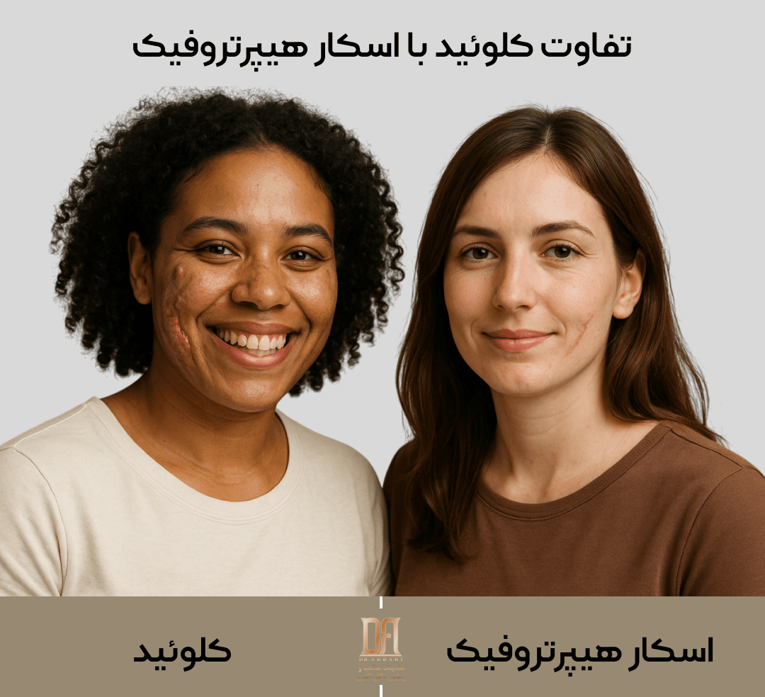 تفاوت کلوئید با اسکار هیپرتروفیک